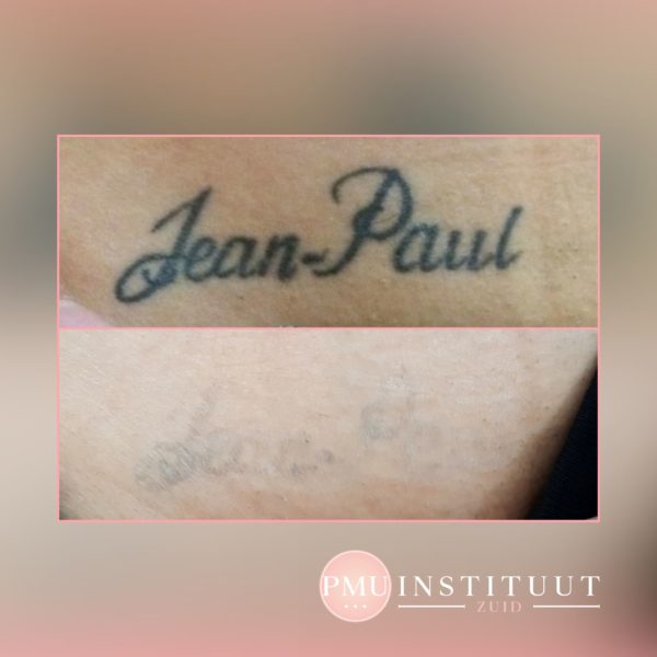 tatoeage-verwijdering