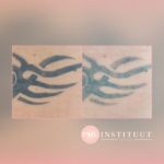 tatoeage-verwijdering
