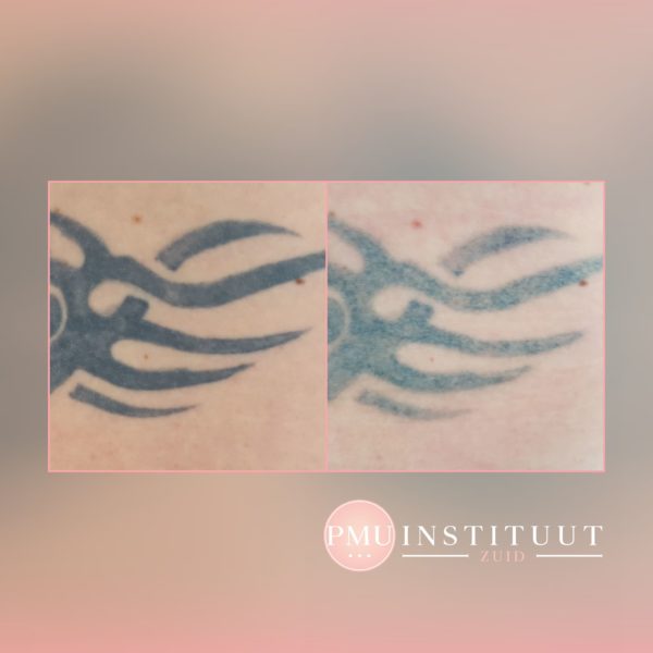 tatoeage-verwijdering