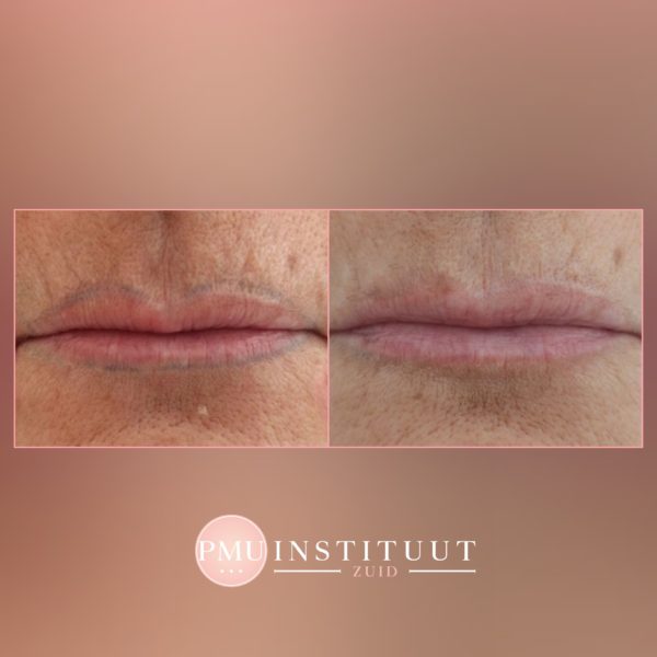 tatoeage-verwijdering