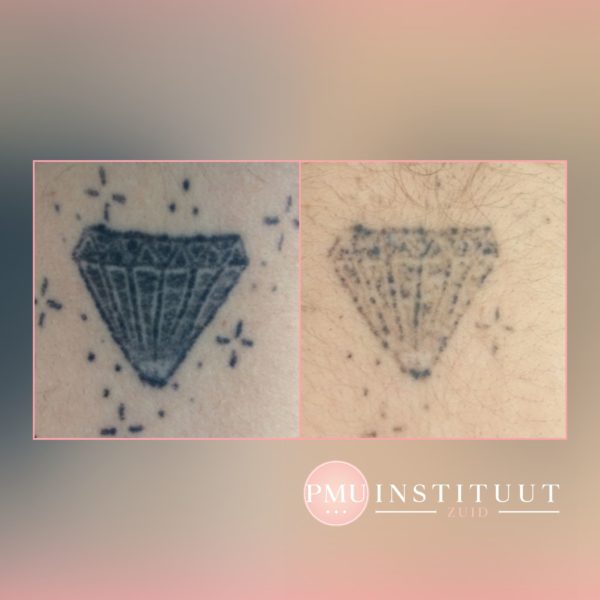 tatoeage-verwijdering