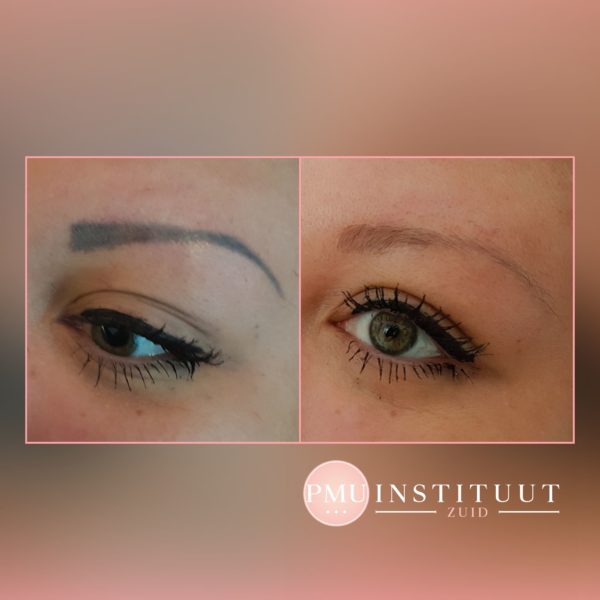 tatoeage-verwijdering