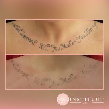 tatoeage-verwijdering