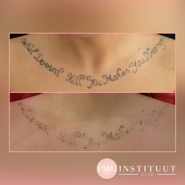 tatoeage-verwijdering