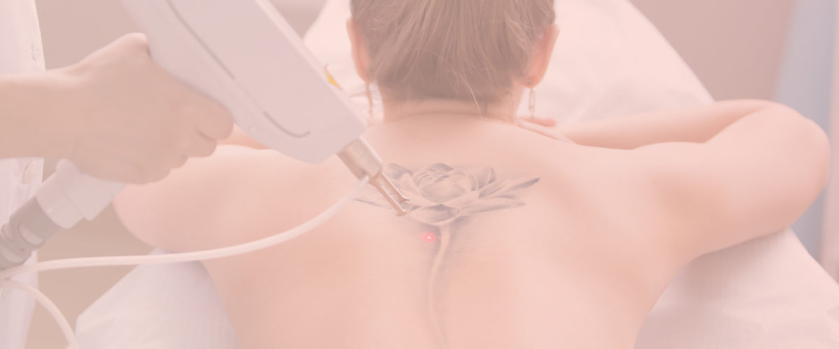 tatoeage-verwijdering