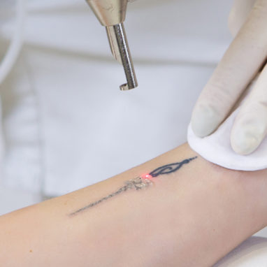 tatoeage-verwijdering