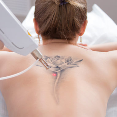 tatoeage-verwijdering