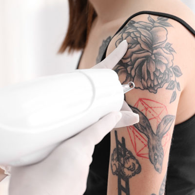 laser-tatoeage-verwijdering